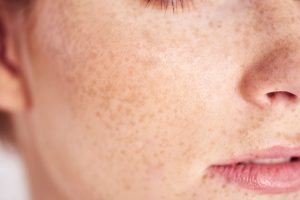CosmeDerm huidtherapie pigmentvlekken
